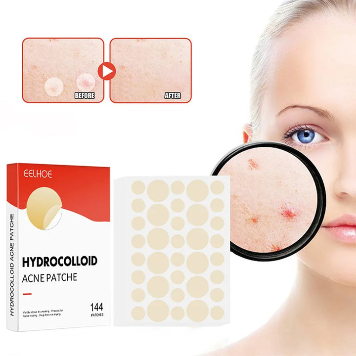 Hydrocolloid Pimple Patches | Acne Pimple Patch | Glamoursh
